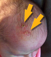 Neonatal herpes simplex virus infection - Knowledge @ AMBOSS