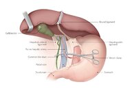 Pancreatic and hepatic surgery - Knowledge @ AMBOSS
