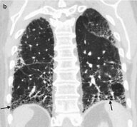 Interstitial lung diseases - Knowledge @ AMBOSS