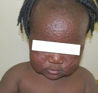 Skin and soft tissue infections - Knowledge @ AMBOSS