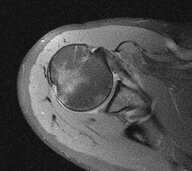 Shoulder dislocation - Knowledge @ AMBOSS