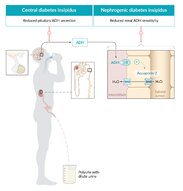 Arginine vasopressin disorders - Knowledge @ AMBOSS