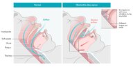 Obstructive sleep apnea - Knowledge @ AMBOSS