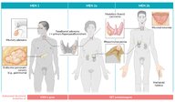 Multiple endocrine neoplasia - Knowledge @ AMBOSS