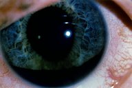 Traumatic eye injuries - Knowledge @ AMBOSS