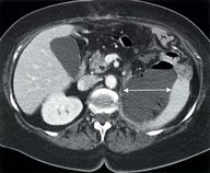 Intraabdominal abscesses - Knowledge @ AMBOSS