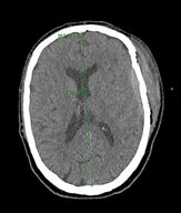 Subarachnoid hemorrhage - Knowledge @ AMBOSS