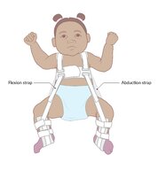 Developmental dysplasia of the hip - Knowledge @ AMBOSS