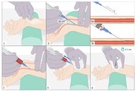Arterial blood gas analysis - Knowledge @ AMBOSS