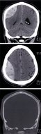 Skull fractures - Knowledge @ AMBOSS