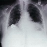 Cardiac implantable electronic devices - Knowledge @ AMBOSS