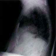 Cardiac implantable electronic devices - Knowledge @ AMBOSS