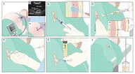 Paracentesis - Knowledge @ AMBOSS