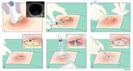 Abscess incision and drainage - Knowledge @ AMBOSS