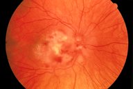 Cytomegalovirus infection - Knowledge @ AMBOSS