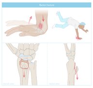 Forearm fractures - Knowledge @ AMBOSS