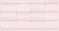 Heart failure - Knowledge @ AMBOSS