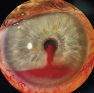 Traumatic eye injuries - Knowledge @ AMBOSS