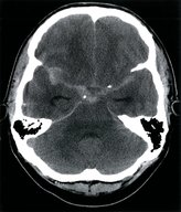 Subarachnoid hemorrhage - Knowledge @ AMBOSS