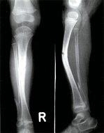 Osteomalacia and rickets - Knowledge @ AMBOSS