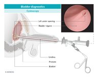 Diagnostic investigations and procedures in urology - Knowledge @ AMBOSS