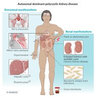 Polycystic kidney disease - Knowledge @ AMBOSS