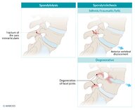 Spondylolisthesis - Knowledge @ AMBOSS