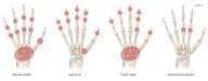 Polyarthritis and oligoarthritis - Knowledge @ AMBOSS