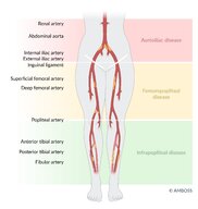 Peripheral arterial disease - Knowledge @ AMBOSS