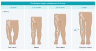 Angular deformities of the lower extremities - Knowledge @ AMBOSS