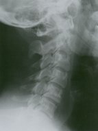 Cervical spine injuries - Knowledge @ AMBOSS