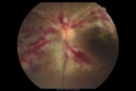 Cytomegalovirus infection - Knowledge @ AMBOSS