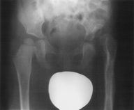 Limp in children - Knowledge @ AMBOSS