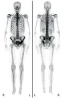 Bone scan - Knowledge @ AMBOSS