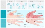 Photodermatoses - Knowledge @ AMBOSS